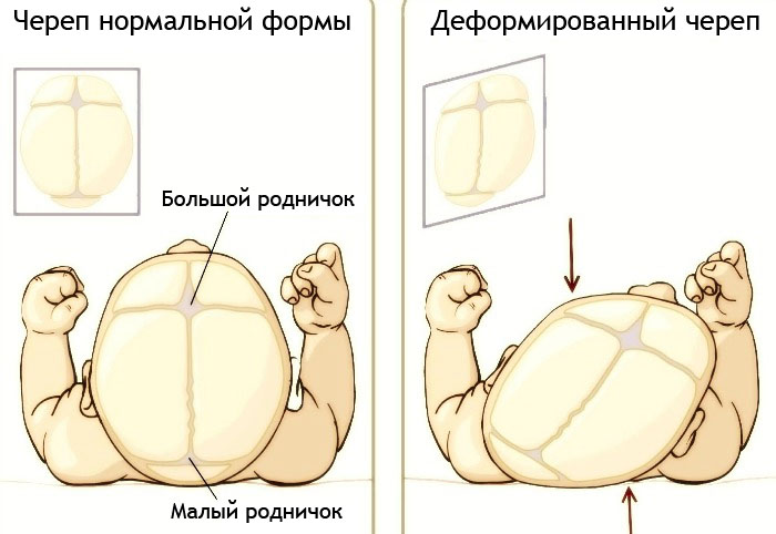 Сравнение форм детского черепа